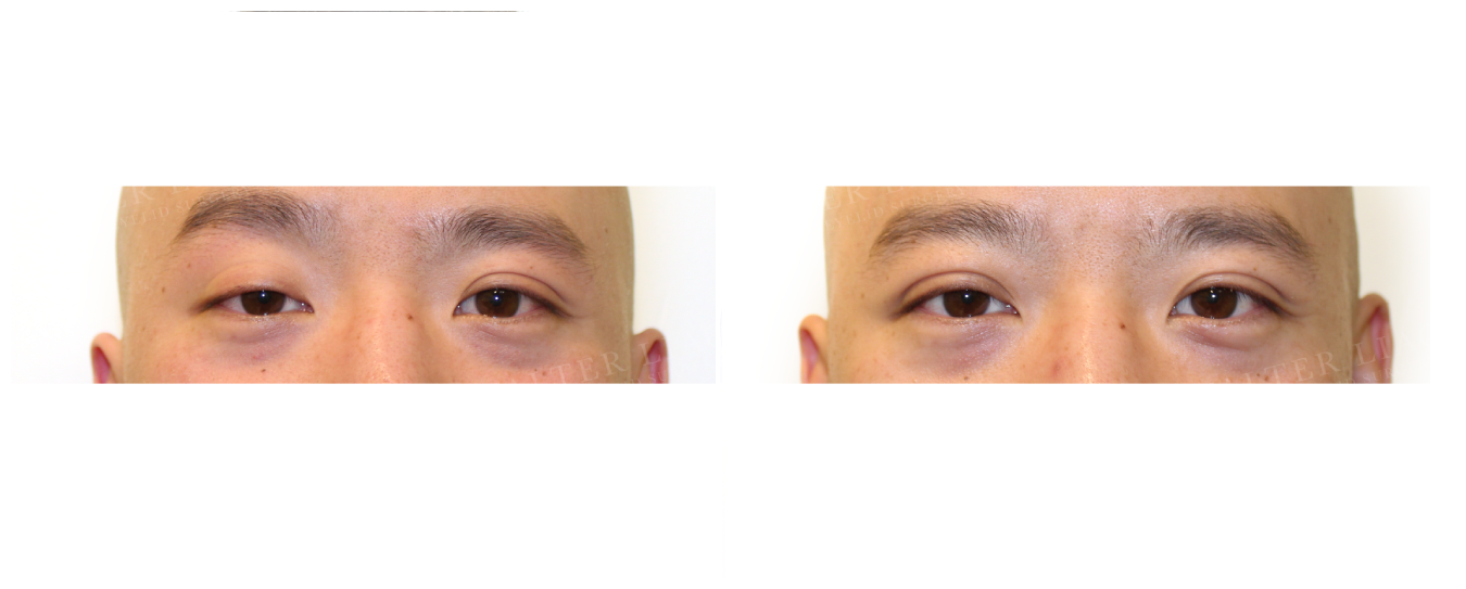 asian double eyelid surgery toronto